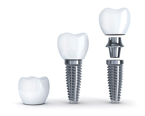 A dental implant consists of the post, abutment, and restoration. A dental implant consists of the post, abutment, and restoration.