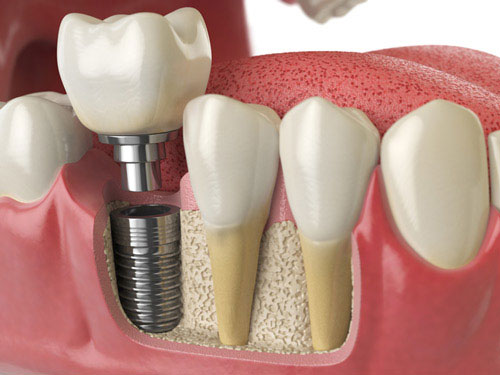 A dental implant surgery involves surgically placing the post and then attaching the abutment and restoration. A dental implant surgery involves surgically placing the post and then attaching the abutment and restoration.