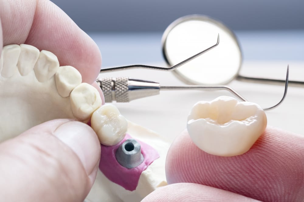 Dental Crowns in Berkeley, CA