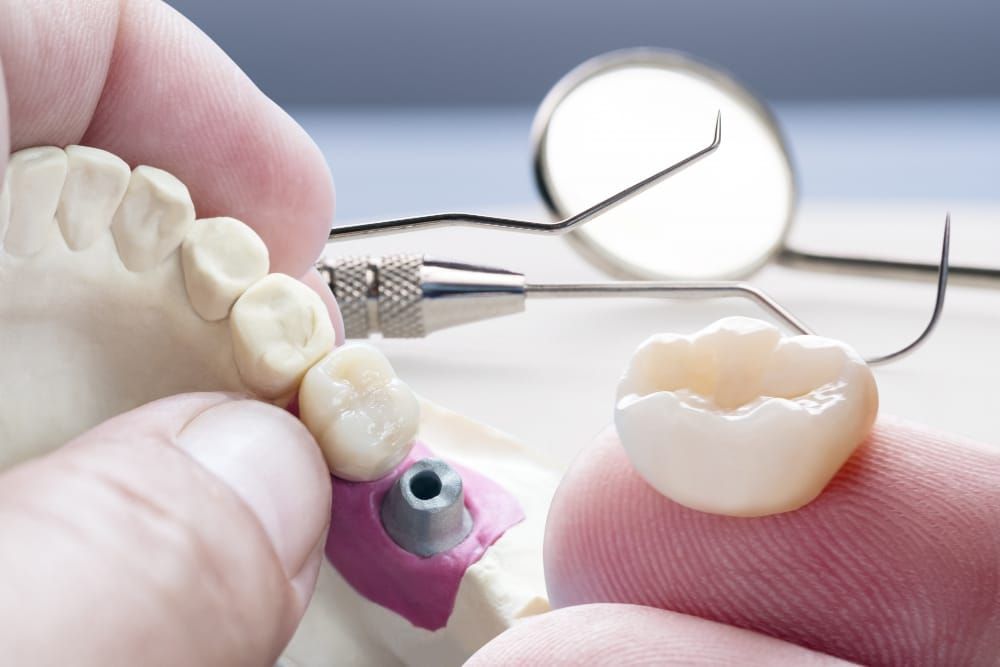 Dental Crowns in Berkeley, CA