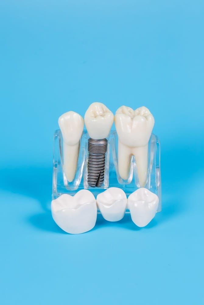 Dental Implants in Berkeley, CA