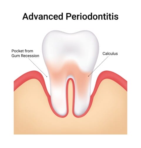 Periodontal Treatment in Berkeley, CA