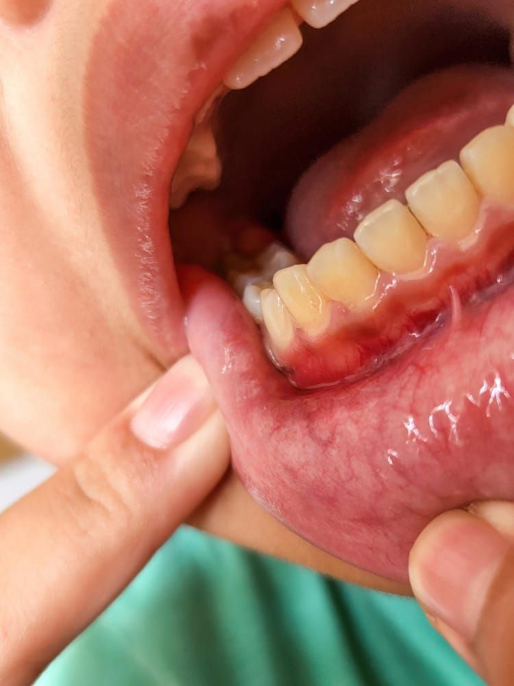 Signs and Symptoms of Gum Disease