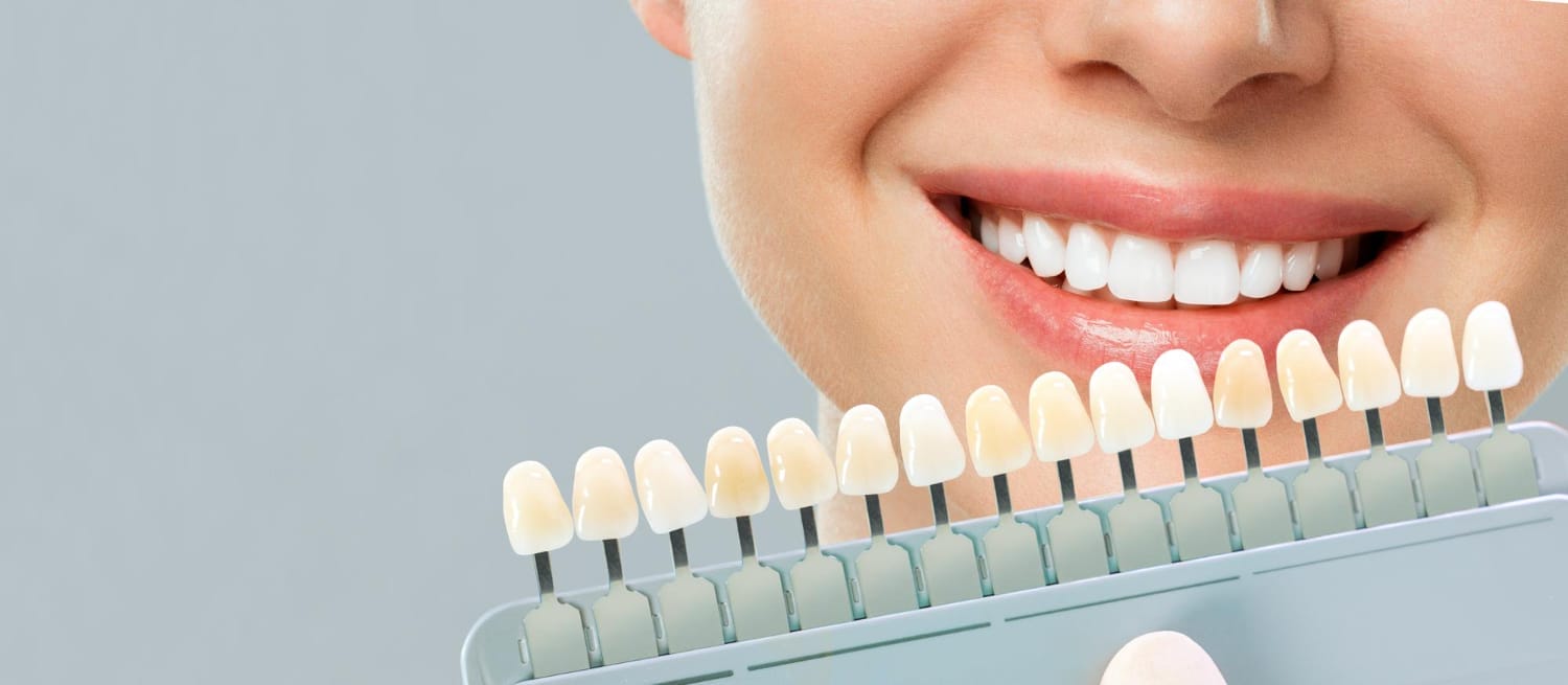 Porcelain Veneers at Acorn Family Dental Care