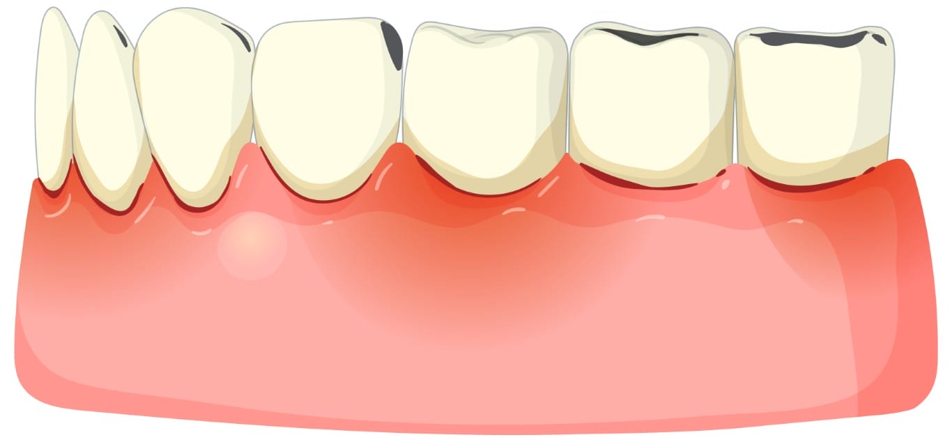 Cracked Tooth Symptoms: 6 Signs You Shouldn't Ignore