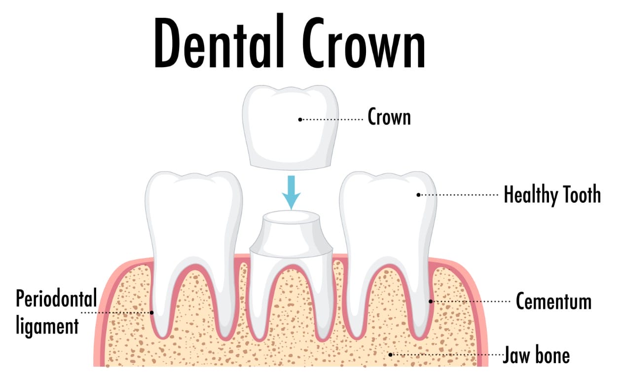 Dental Crown Fell Off? Here's Exactly What to Do