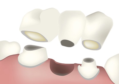Dental Bridges at Dailley Dental Care 