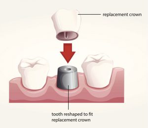 Dental Crowns