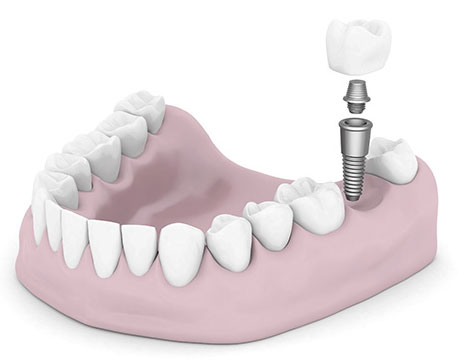 Dental implants are a great solution to missing teeth, because they replace the true look and function of a real tooth.