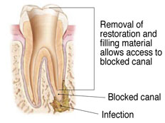 Root Canal diagram from Anthony Dailley, DDS
