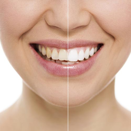 Before and after teeth whitening at Dailley Dental Care