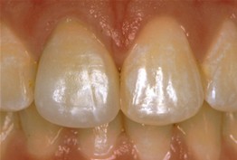 close up of patient's smile after receiving dental crowns