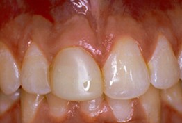 close up of patient's smile before receiving dental crowns