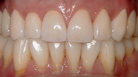 close-up of patient's smile after receiving dental crowns