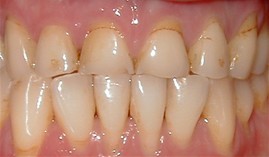 close-up of patient's smile before receiving dental crowns