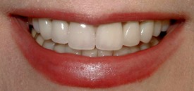 close-up of patient's smile after receiving dental crowns