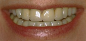 close up of patients smile before receiving dental crowns