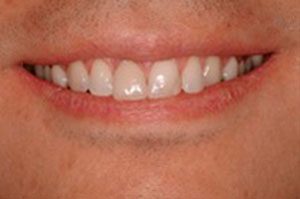 close up of patients'smile after receiving dental implants