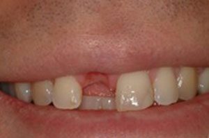 close-up of patient's smile before receiving dental implants