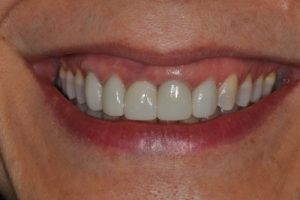 close-up of a patient's smile after a restorative procedure