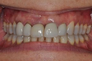 close up of a patient's smile before a restorative procedure